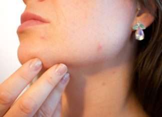 Home Remedies for Acne – How to Get Rid of Them Forever Home remedies for acne