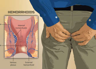 Causes of Piles and Symptoms to Diagnose the Chronic Condition Early causes of piles