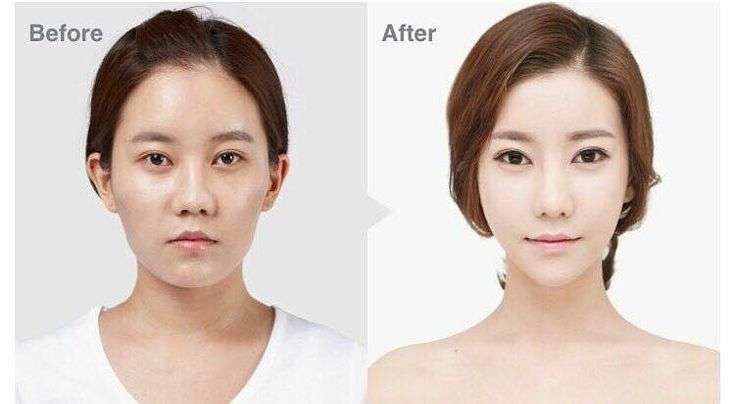 Yeonmi Park Plastic Surgery