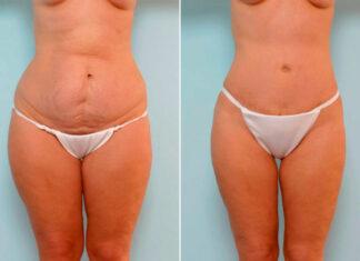 How Exercise Helps Maintain Your Tummy Tuck Results