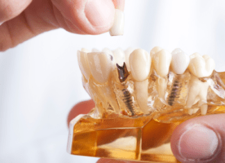 Why Dental Implants Are the Best Solution for Missing Teeth: Insights from Dr. Sehat