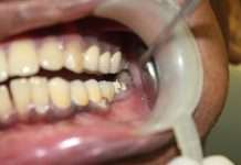 A Comprehensive Guide to PFM Porcelain-Fused-to-Metal Crowns