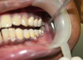 A Comprehensive Guide to PFM Porcelain-Fused-to-Metal Crowns